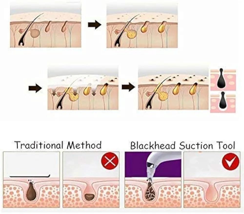 Blackhead Remover 6 in 1 Multi-function and Whitehead Remover Device oil out of your skin - Image 5